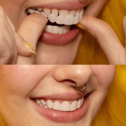 لمینت دندان دو فک مدل TruSmile به همراه نوار چسب سفیدکننده دندان